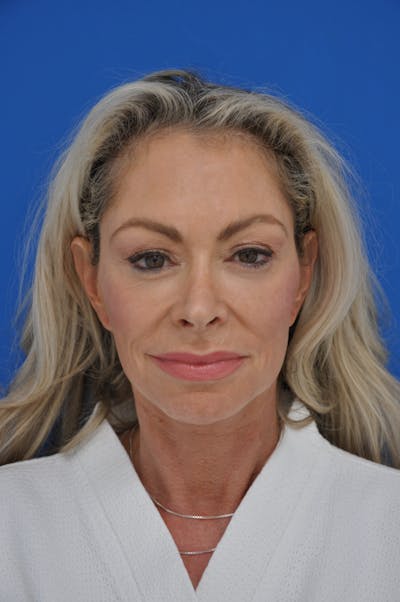 Facelift Before & After Gallery - Patient 148756420 - Image 1