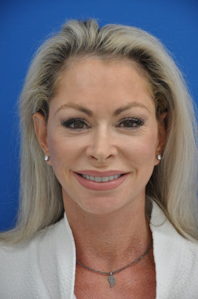 Facelift Before & After Gallery - Patient 148756420 - Image 2