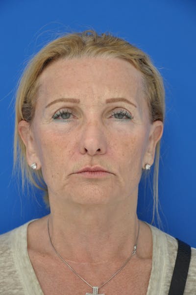 Facelift Before & After Gallery - Patient 148756582 - Image 1