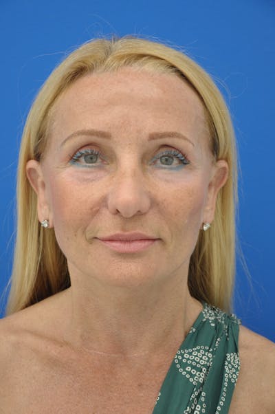 Facelift Before & After Gallery - Patient 148756582 - Image 2