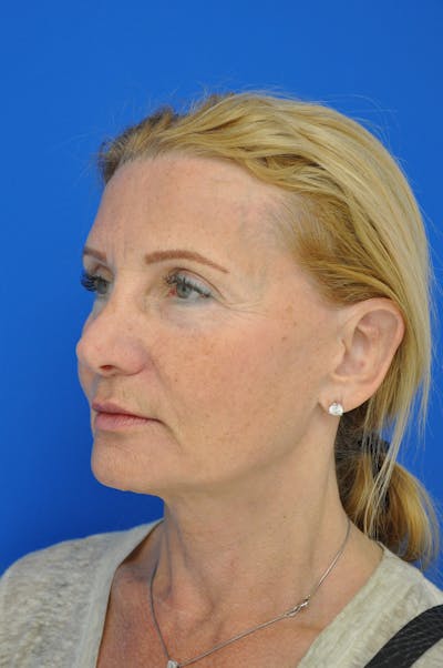 Facelift Before & After Gallery - Patient 148756582 - Image 1