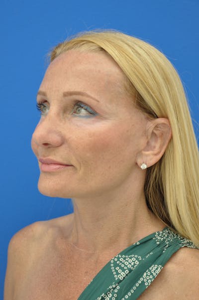 Facelift Before & After Gallery - Patient 148756582 - Image 2