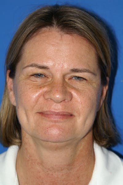 Facelift Before & After Gallery - Patient 148756583 - Image 1