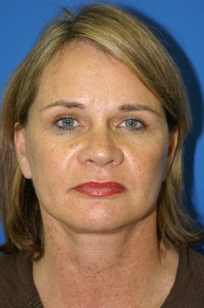 Facelift Before & After Gallery - Patient 148756583 - Image 2
