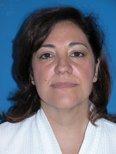 Facelift Before & After Gallery - Patient 148756584 - Image 1