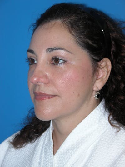 Facelift Before & After Gallery - Patient 148756584 - Image 2