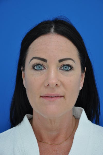 Facelift Before & After Gallery - Patient 148756922 - Image 1
