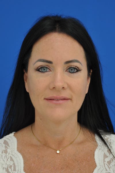 Facelift Before & After Gallery - Patient 148756922 - Image 2