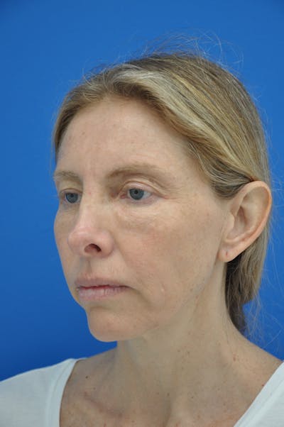 Facelift Before & After Gallery - Patient 148756992 - Image 1