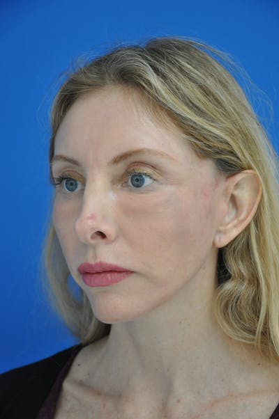 Facelift Before & After Gallery - Patient 148756992 - Image 2