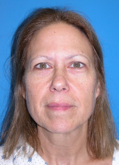Facelift Before & After Gallery - Patient 148757007 - Image 1