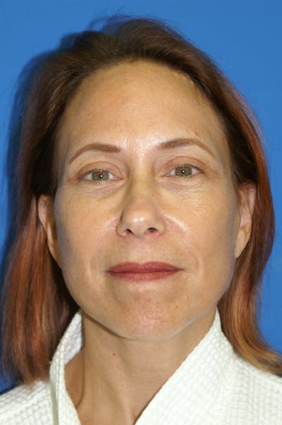 Facelift Before & After Gallery - Patient 148757007 - Image 2