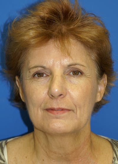 Facelift Before & After Gallery - Patient 148757085 - Image 1