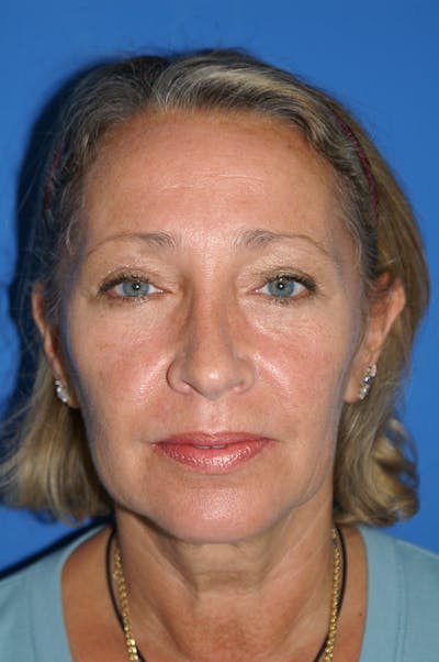 Facelift Before & After Gallery - Patient 148757552 - Image 1