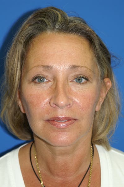 Facelift Before & After Gallery - Patient 148757552 - Image 2