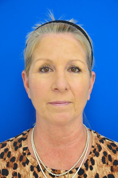 Facelift Before & After Gallery - Patient 148757555 - Image 1