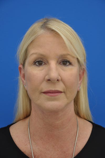 Facelift Before & After Gallery - Patient 148757555 - Image 2