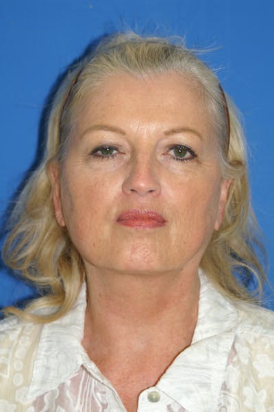 Facelift Before & After Gallery - Patient 148757557 - Image 1