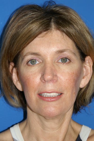 Facelift Before & After Gallery - Patient 148757668 - Image 2