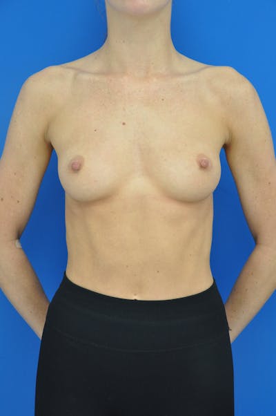 Breast Augmentation Before & After Gallery - Patient 157556490 - Image 1