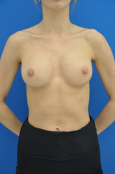 Breast Augmentation Before & After Gallery - Patient 157556490 - Image 2