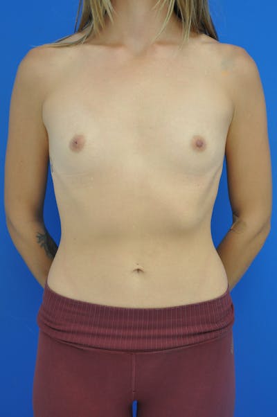 Breast Augmentation Before & After Gallery - Patient 157556524 - Image 1