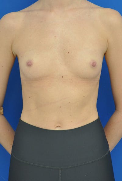 Breast Augmentation Before & After Gallery - Patient 338647 - Image 1