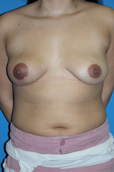Breast Reduction Before & After Gallery - Patient 128580 - Image 2