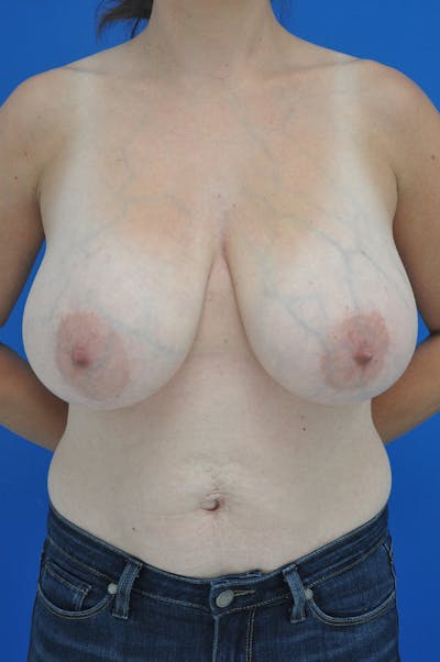 Breast Reduction Before & After Gallery - Patient 370179 - Image 1