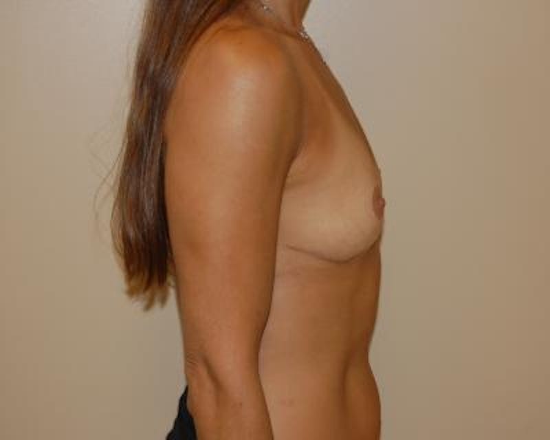 Breast Implant Removal Before & After Gallery - Patient 120184279 - Image 6