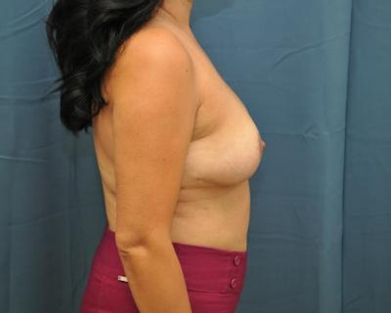 Breast Implant Removal Before & After Gallery - Patient 120184283 - Image 4