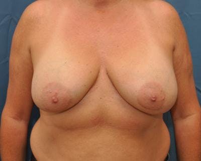 Breast Implant Removal Before & After Gallery - Patient 120184286 - Image 1