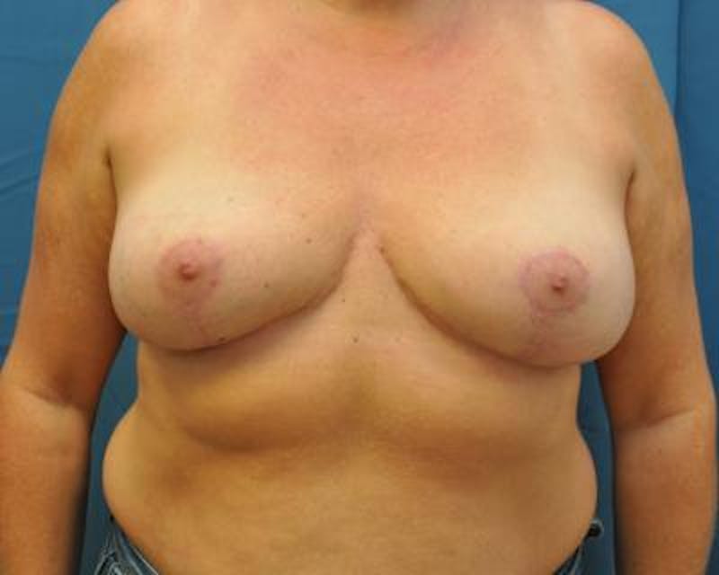 Breast Implant Removal Before & After Gallery - Patient 120184286 - Image 2