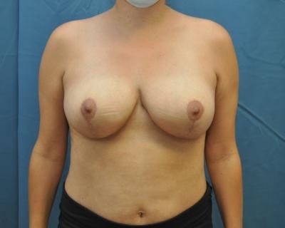 Breast Reduction Before & After Gallery - Patient 120184648 - Image 2