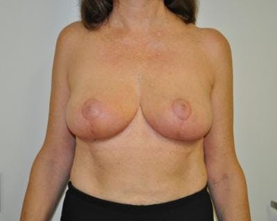 Breast Reduction Before & After Gallery - Patient 120184651 - Image 2