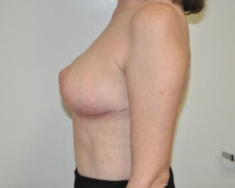 Breast Reduction Before & After Gallery - Patient 120184651 - Image 4