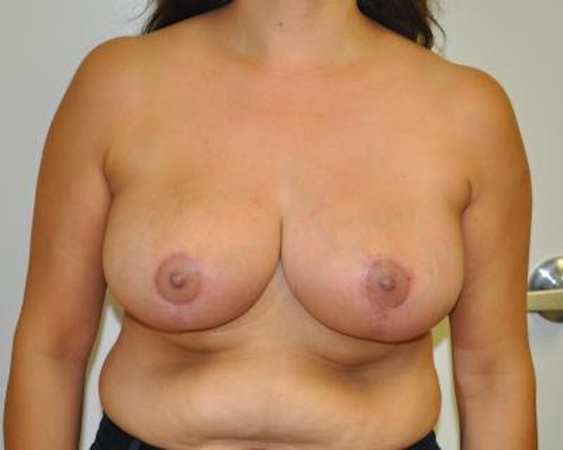 Breast Reduction Gallery - Patient 120184653 - Image 2