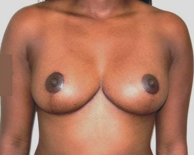 Breast Reduction Before & After Gallery - Patient 120184656 - Image 2