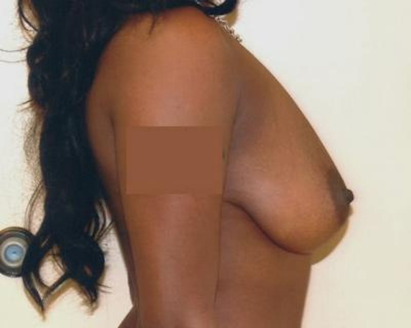 Breast Reduction Before & After Gallery - Patient 120184656 - Image 3