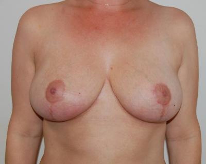 Breast Reduction Before & After Gallery - Patient 120184658 - Image 2