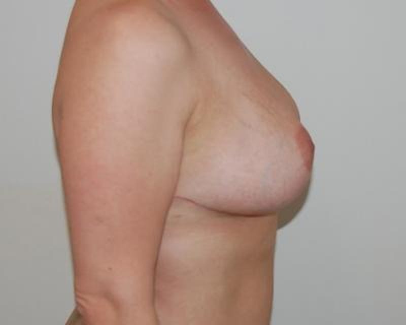 Breast Reduction Before & After Gallery - Patient 120184658 - Image 4