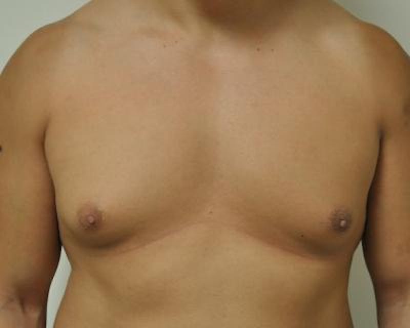 Male Breast Reduction Before & After Gallery - Patient 120195673 - Image 1