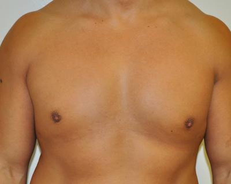 Male Breast Reduction Gallery - Patient 120195673 - Image 2