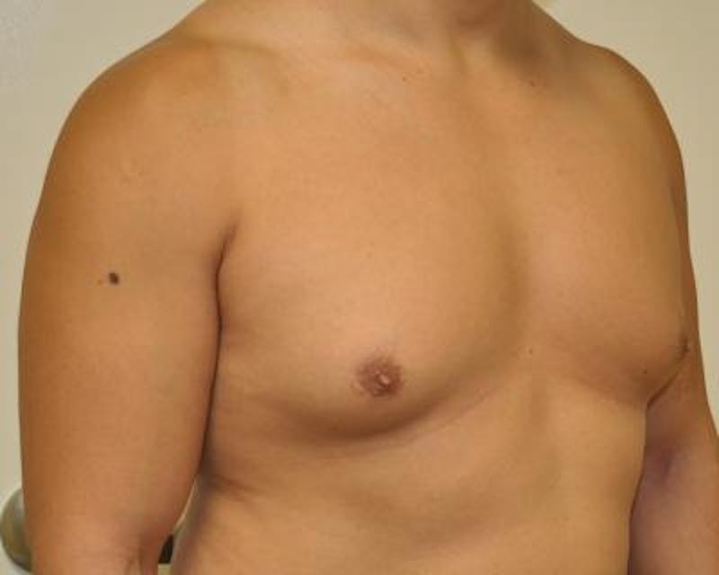 Male Breast Reduction Gallery - Patient 120195673 - Image 3