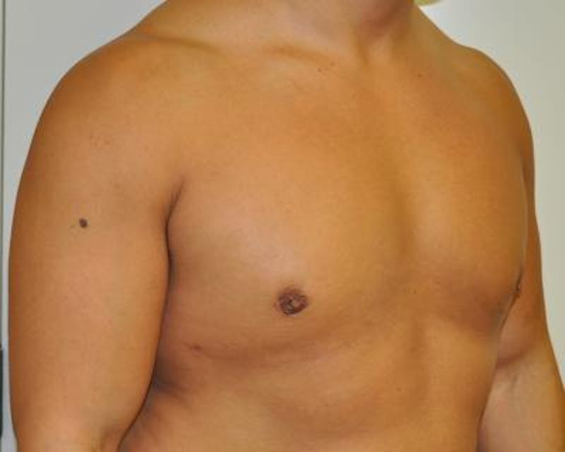 Male Breast Reduction Gallery - Patient 120195673 - Image 4