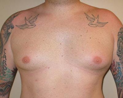 Male Breast Reduction Before & After Gallery - Patient 120195675 - Image 1