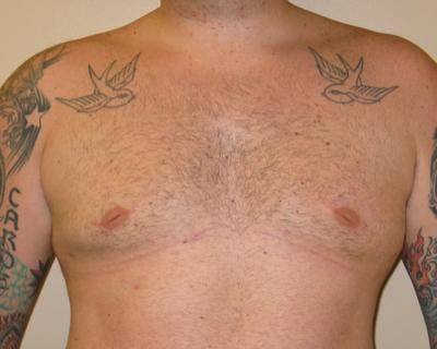 Male Breast Reduction Before & After Gallery - Patient 120195675 - Image 2