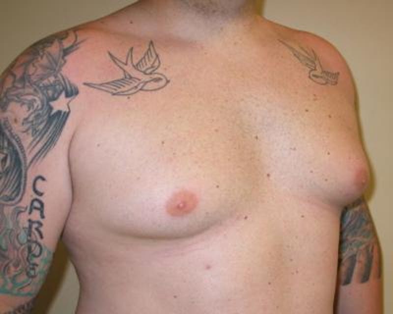 Male Breast Reduction Gallery - Patient 120195675 - Image 3