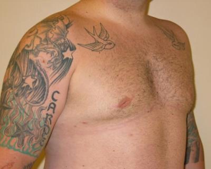 Male Breast Reduction Before & After Gallery - Patient 120195675 - Image 4