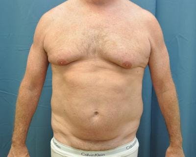 Male Breast Reduction Before & After Gallery - Patient 120195676 - Image 1